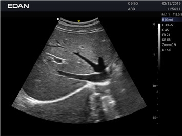 EDAN Acclarix AX2