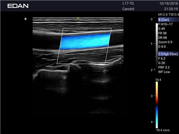 EDAN Acclarix AX2